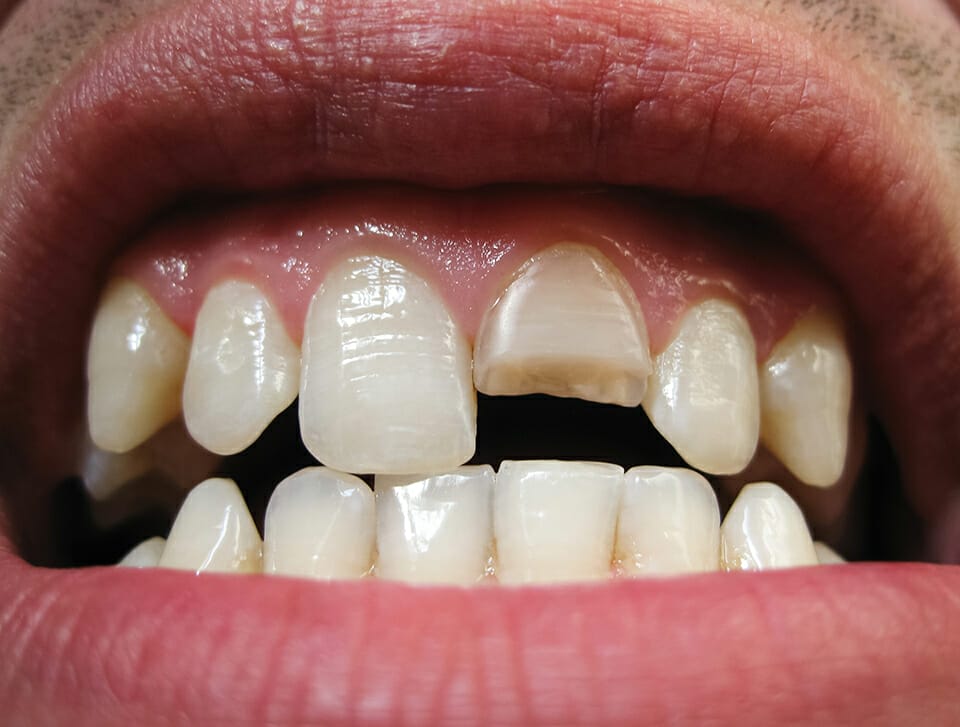 A close up of a man's mouth with teeth missing.